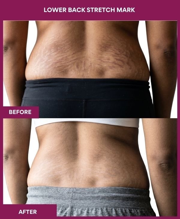 Lower-Back-Stretch-Mark-treatment-before-after-results-mumbai-india-patient05