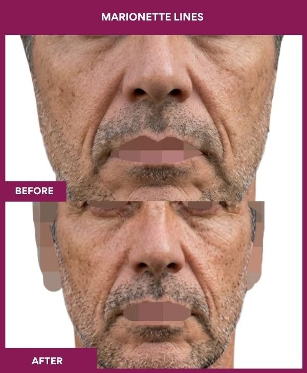 Marionette-Lines-wrinkle-removal-treatment-before-after-results-mumbai-india-patient08-front