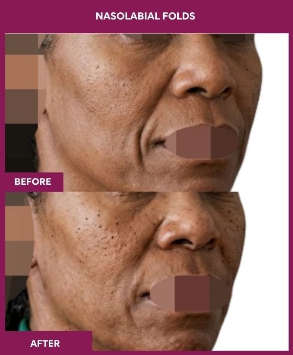 Nasolabial-Folds-wrinkle-removal-treatment-before-after-results-mumbai-india-patient10-side-left