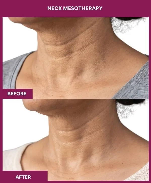 Neck-mesotherapy-treatment-before-after-results-mumbai-patient06