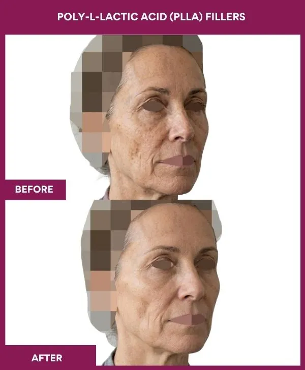 Poly-L-Lactic-Acid-(PLLA)-Fillers-treatment-before-after-results-mumbai-india-patient04-side-right