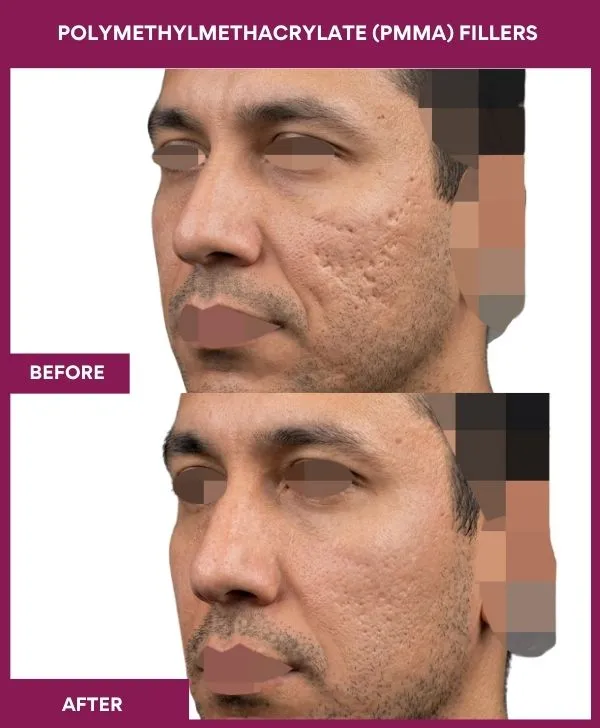 Polymethylmethacrylate-(PMMA)-Fillers-treatment-before-after-results-mumbai-india-patient01-side-left