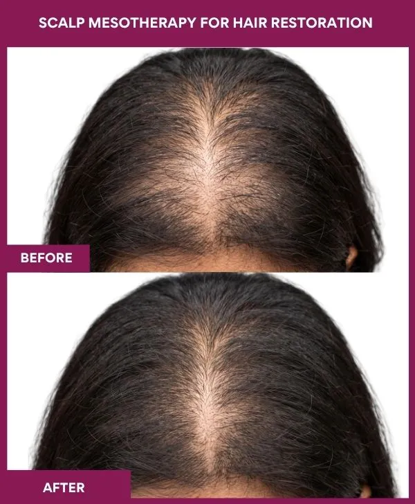 Scalp-mesotherapy-for-hair-restoration-treatment-before-after-results-mumbai-patient07