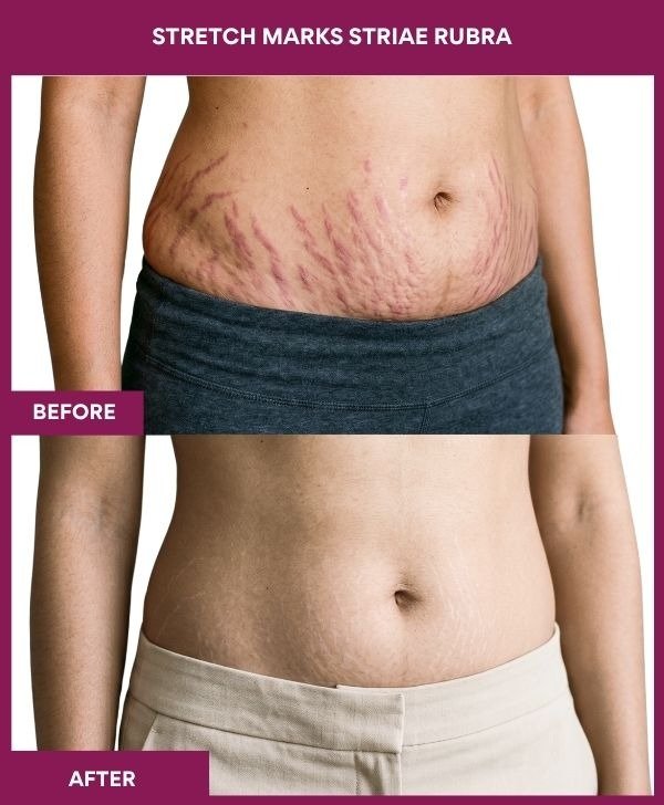 Stretch-marks-striae-alba-treatment-before-after-results-mumbai-india-patient07