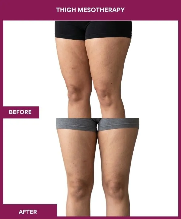 Thigh-mesotherapy-treatment-before-after-results-mumbai-patient08