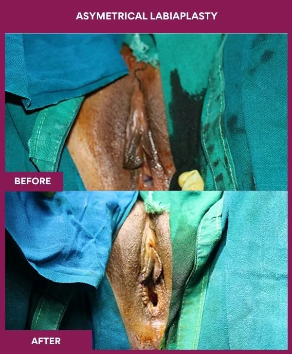 asymmetrical-labiaplasty-before-after-results-mumbai-india-patient02-front-closed