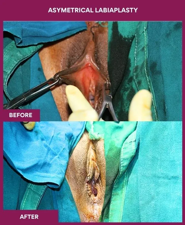 asymmetrical-labiaplasty-before-after-results-mumbai-india-patient02-front-open