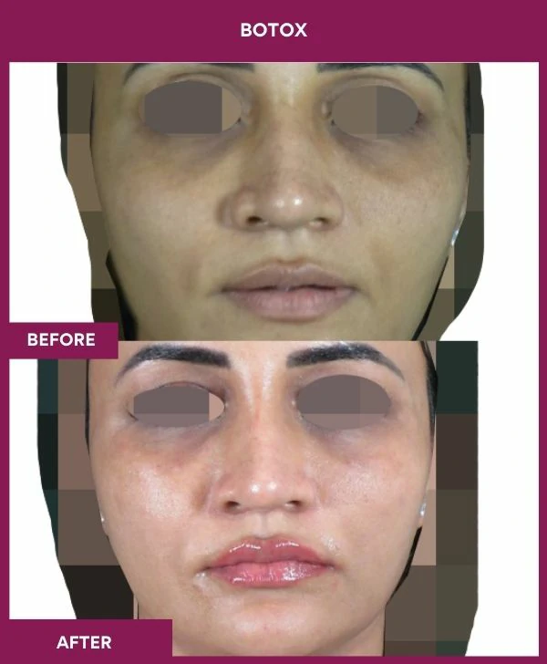 botox-injection-before-after-results-mumbai-india-patient01-front
