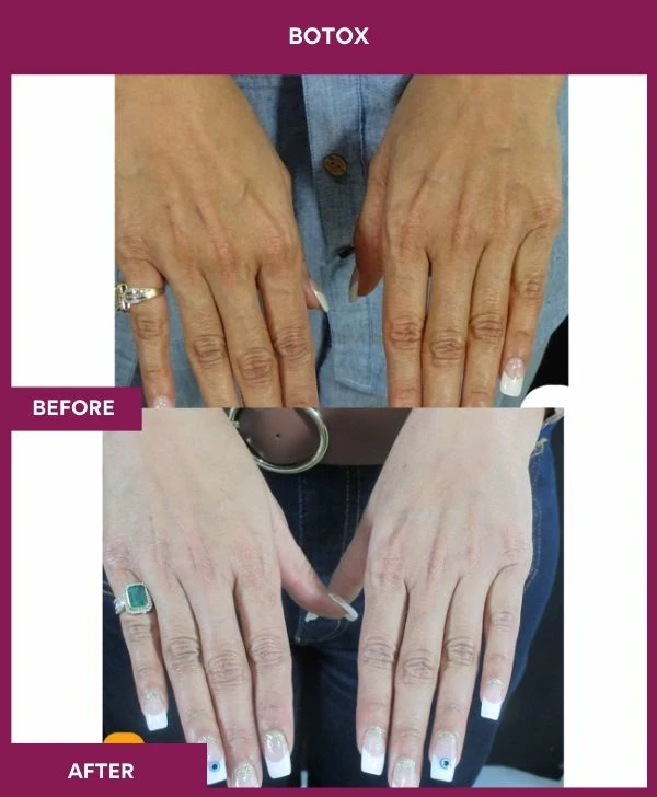 botox-injection-before-after-results-mumbai-india-patient01-hand
