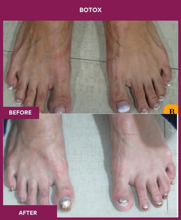 botox-injection-before-after-results-mumbai-india-patient01-leg