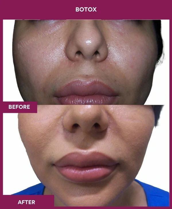botox-injection-before-after-results-mumbai-india-patient02-front