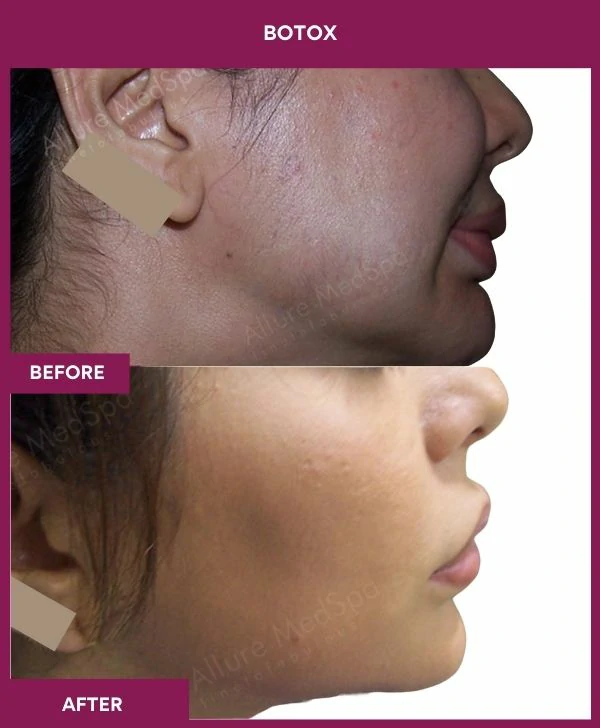 botox-injection-before-after-results-mumbai-india-patient02-side-left