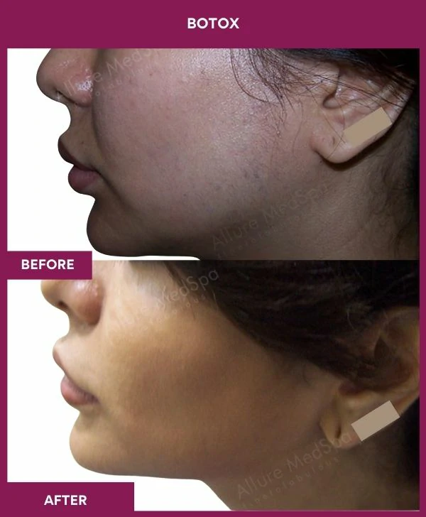 botox-injection-before-after-results-mumbai-india-patient02-side-right