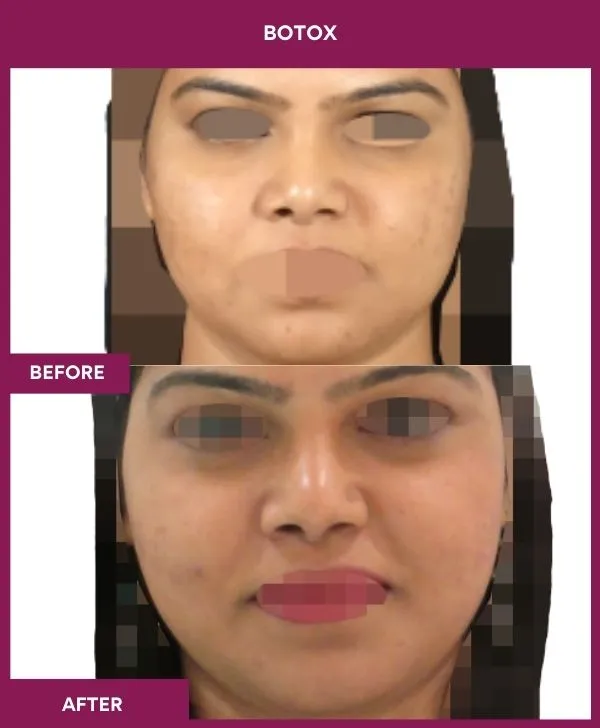 botox-injection-before-after-results-mumbai-india-patient03-front
