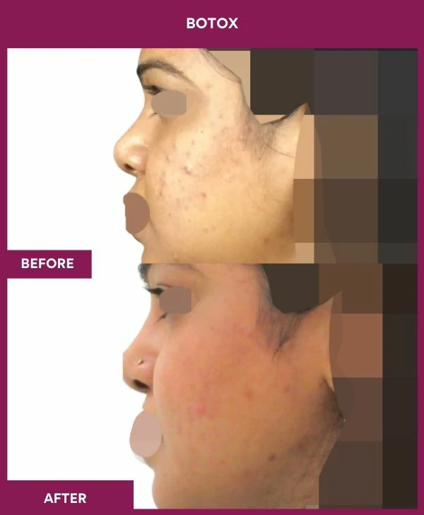 botox-injection-before-after-results-mumbai-india-patient03-side-left