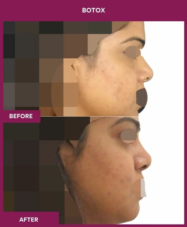 botox-injection-before-after-results-mumbai-india-patient03-side-right