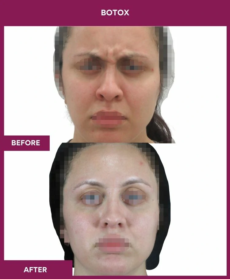 botox-injection-before-after-results-mumbai-india-patient04-front