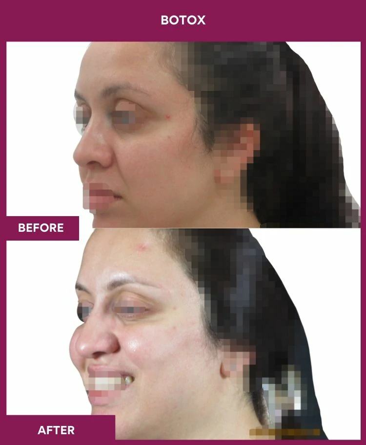 botox-injection-before-after-results-mumbai-india-patient04-side-left