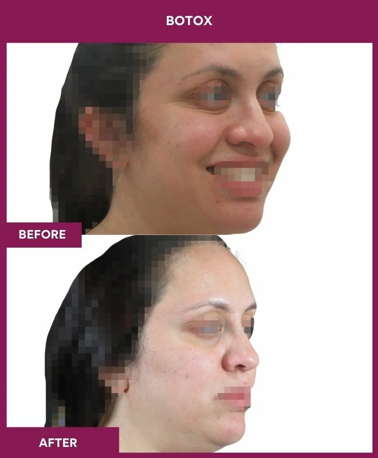 botox-injection-before-after-results-mumbai-patient04-side-india-right