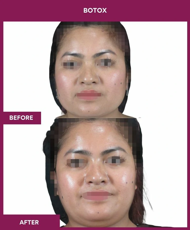 botox-injection-before-after-results-mumbai-india-patient05-front