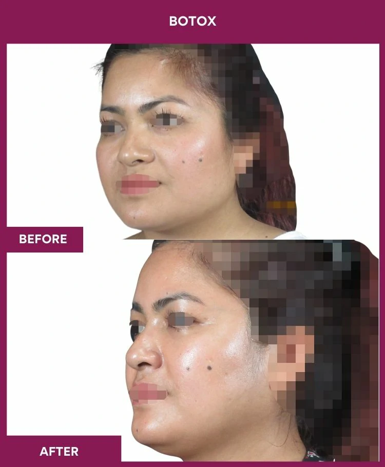 botox-injection-before-after-results-mumbai-india-patient05-side-left