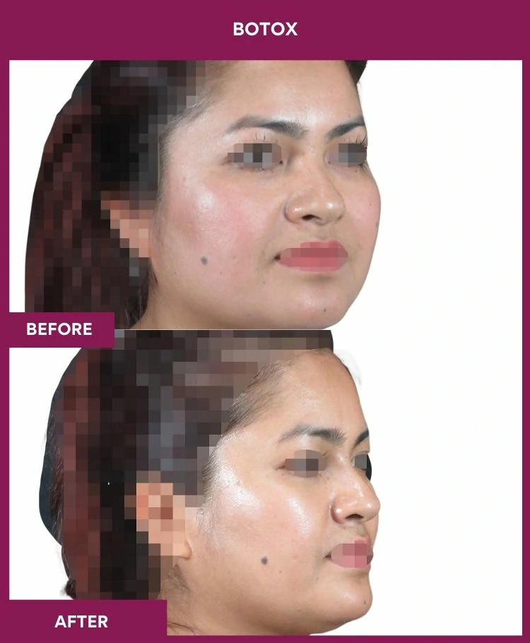 botox-injection-before-after-results-mumbai-india-patient05-side-right