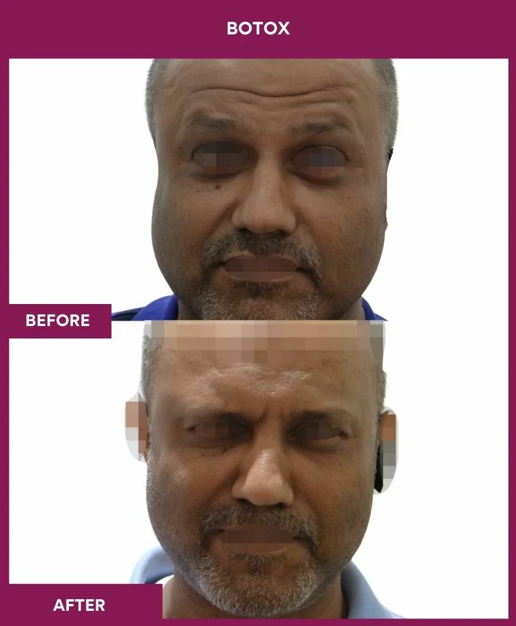 botox-injection-before-after-results-mumbai-india-patient06-front