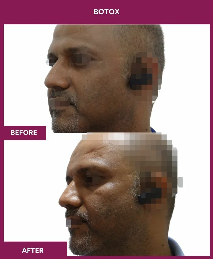 botox-injection-before-after-results-mumbai-india-patient06-side-left