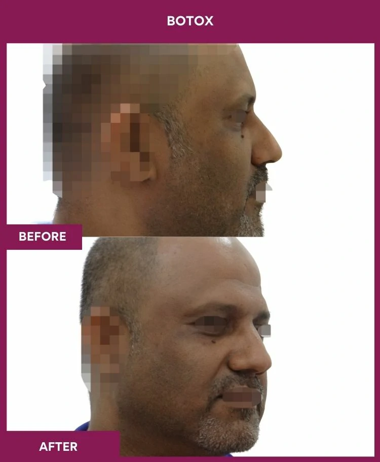 botox-injection-before-after-results-mumbai-patient06-side-india-right