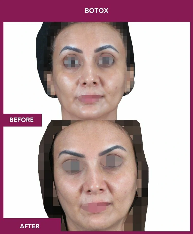botox-injection-before-after-results-mumbai-india-patient07-front