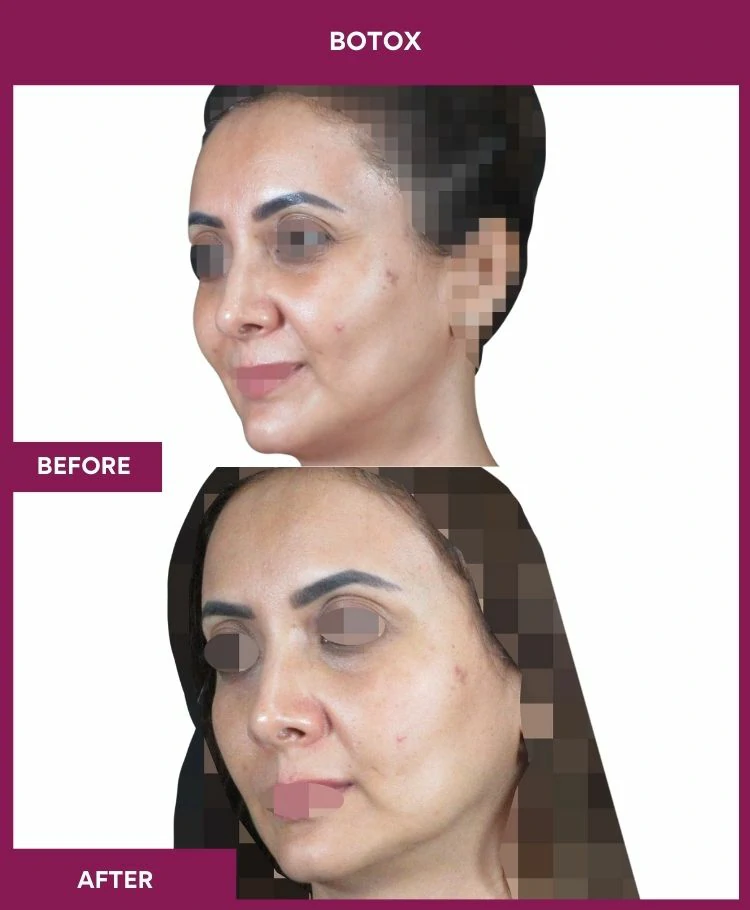 botox-injection-before-after-results-mumbai-india-patient07-side-left