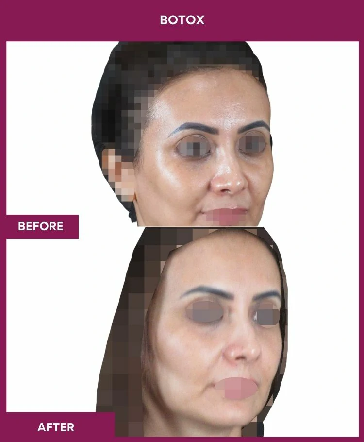 botox-injection-before-after-results-mumbai-india-patient07-side-right