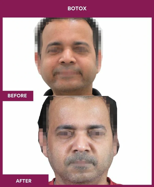 botox-injection-before-after-results-mumbai-india-patient08-front