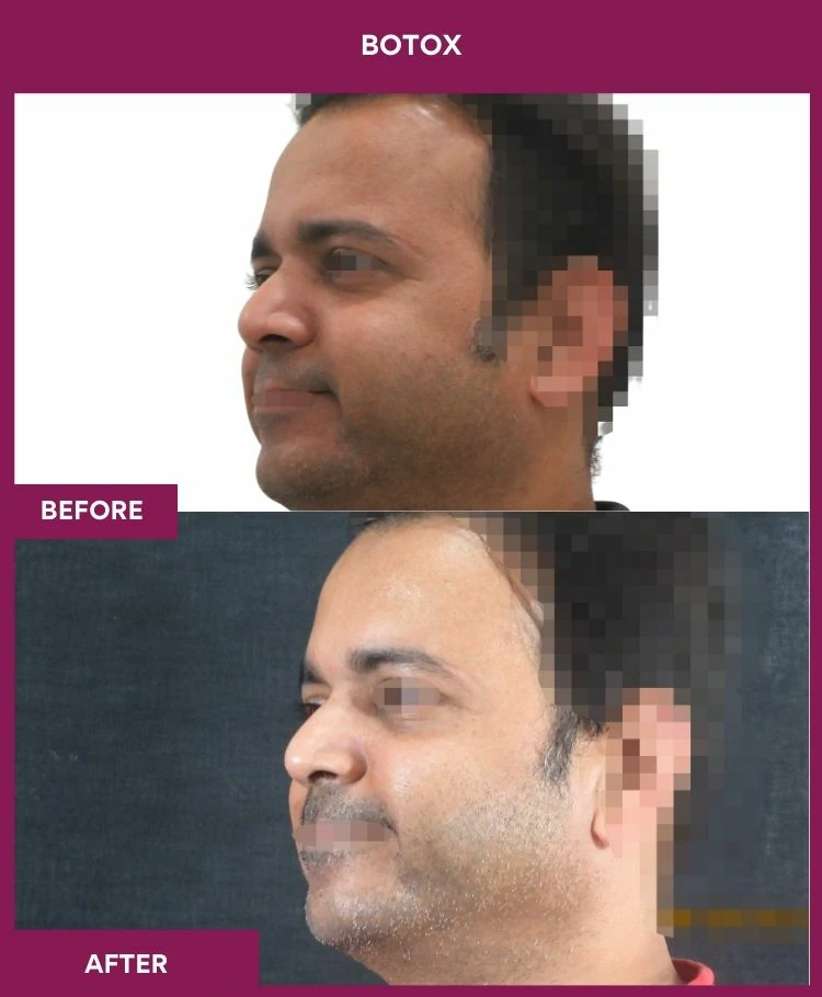 botox-injection-before-after-results-mumbai-india-patient08-side-left