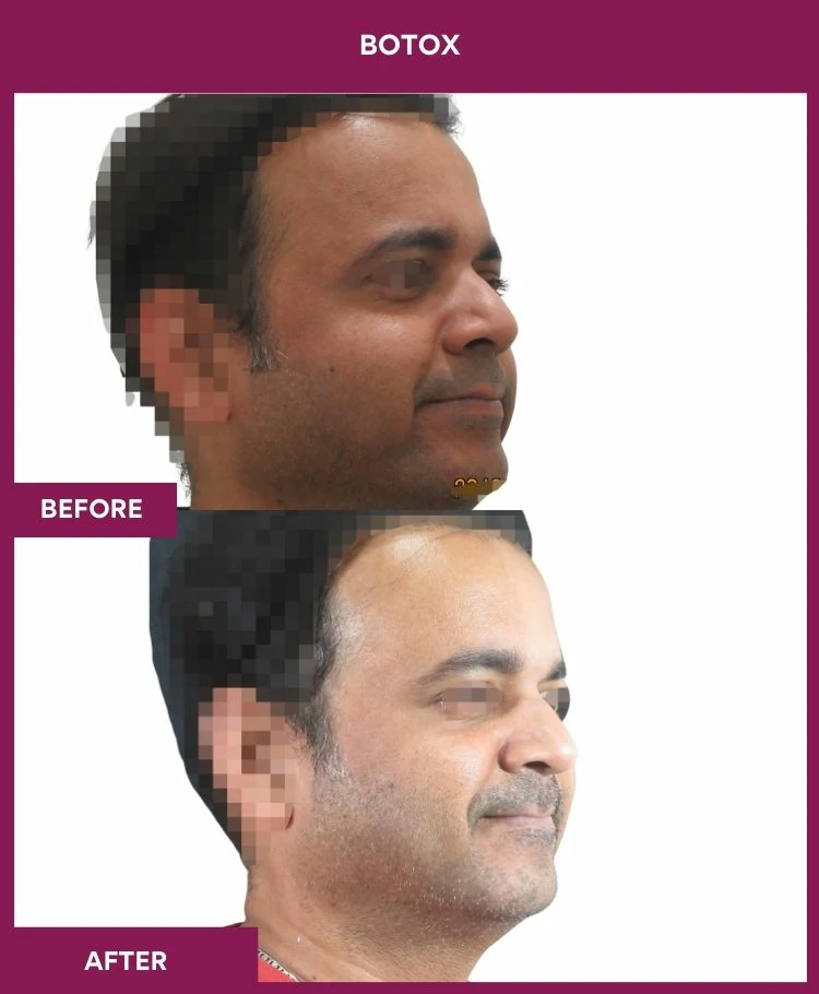 botox-injection-before-after-results-mumbai-india-patient08-side-right
