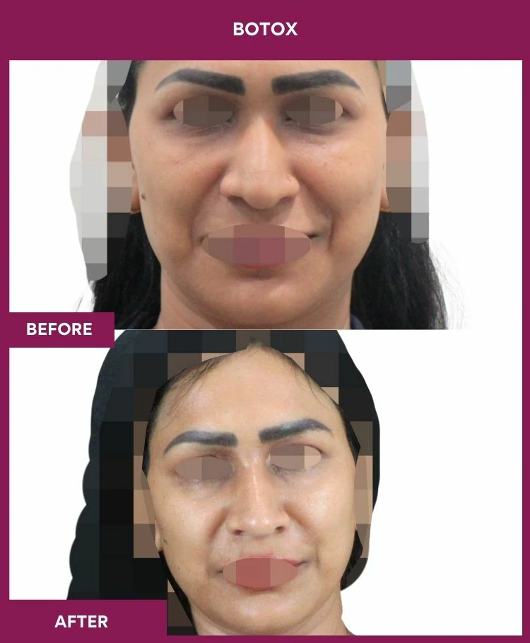 botox-injection-before-after-results-mumbai-india-patient09-front