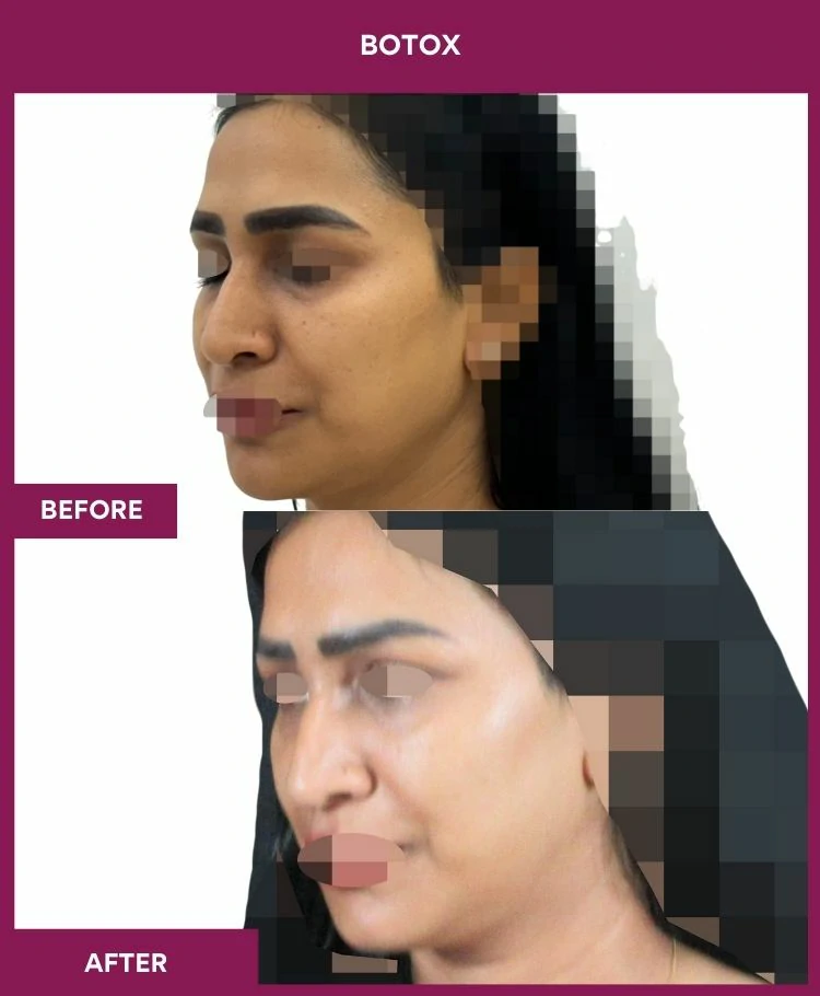 botox-injection-before-after-results-mumbai-india-patient09-side-left