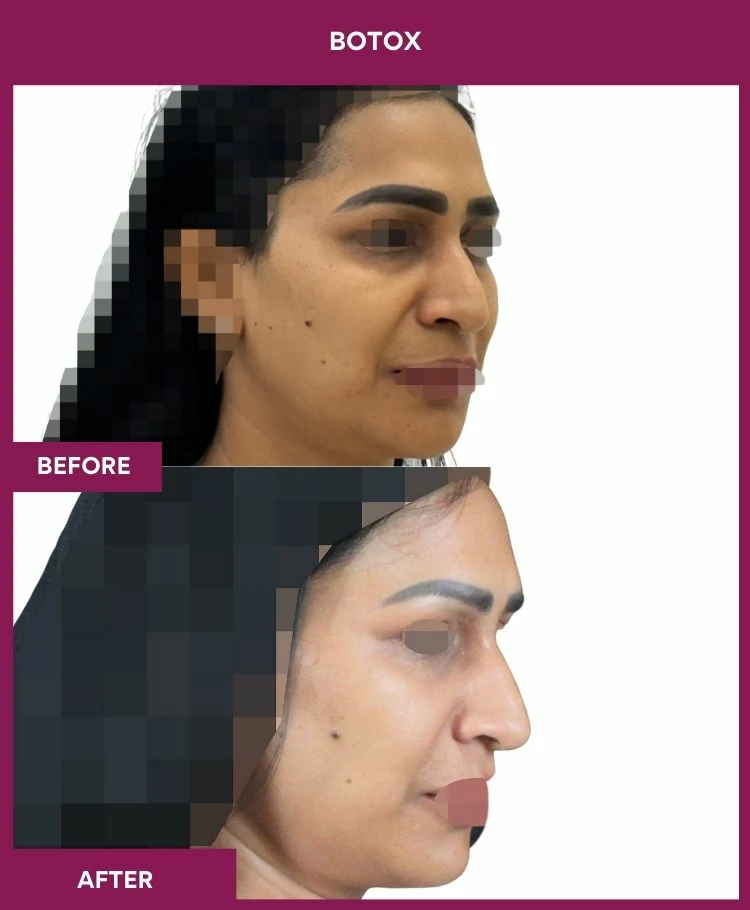 botox-injection-before-after-results-mumbai-india-patient09-side-right