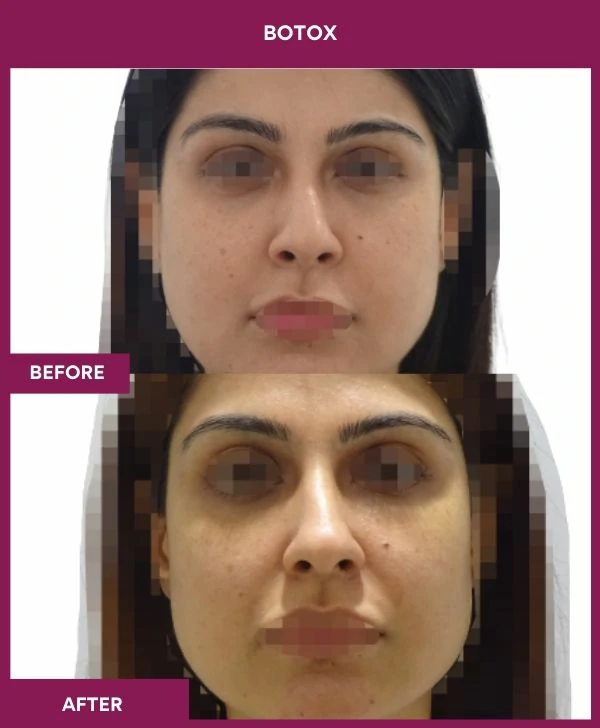 botox-injection-before-after-results-mumbai-india-patient10-front