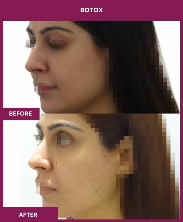 botox-injection-before-after-results-mumbai-india-patient10-side-left
