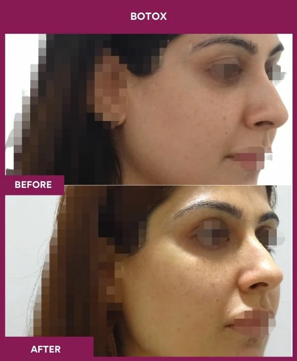 botox-injection-before-after-results-mumbai-india-patient10-side-right