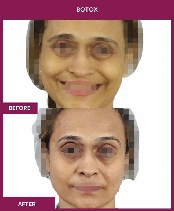 botox-injection-before-after-results-mumbai-india-patient11-front