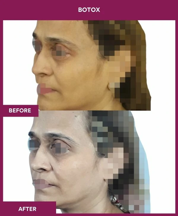 botox-injection-before-after-results-mumbai-india-patient11-side-left