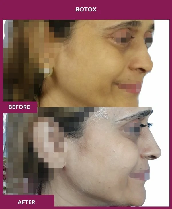 botox-injection-before-after-results-mumbai-india-patient11-side-right
