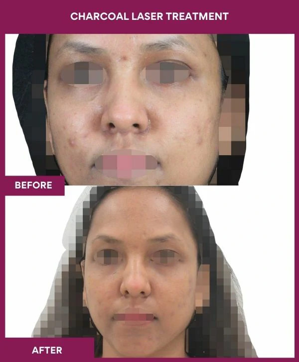 carbon-laser-treatment-before-after-results-mumbai-india-patient02-front