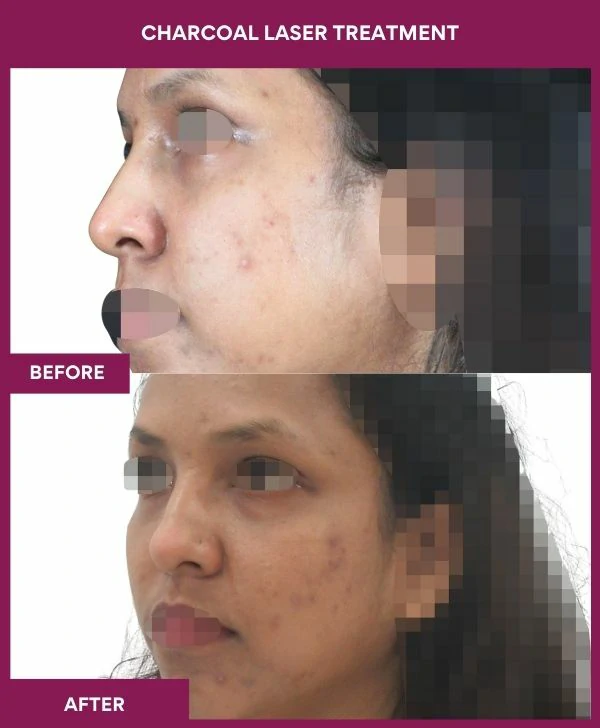 carbon-laser-treatment-before-after-results-mumbai-india-patient02-side-left