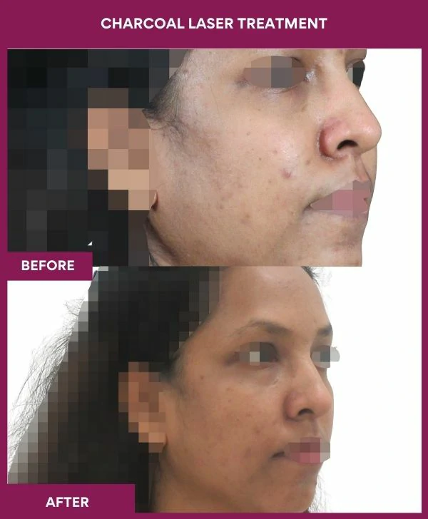 carbon-laser-treatment-before-after-results-mumbai-india-patient02-side-right