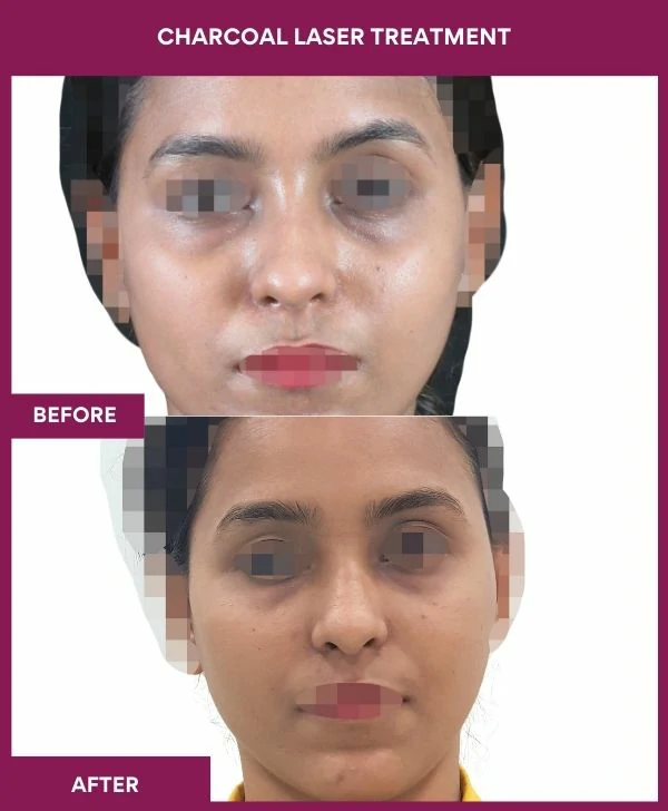carbon-laser-treatment-before-after-results-mumbai-india-patient03-front