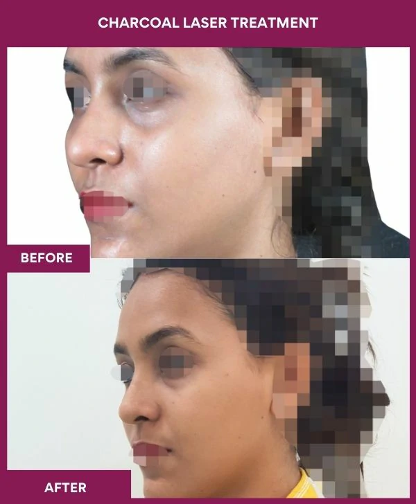 carbon-laser-treatment-before-after-results-mumbai-india-patient03-side-left