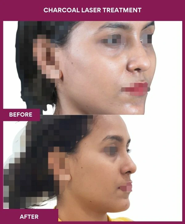 carbon-laser-treatment-before-after-results-mumbai-india-patient03-side-right